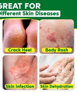 Tinea Cream,Herbal Tinealess Cream