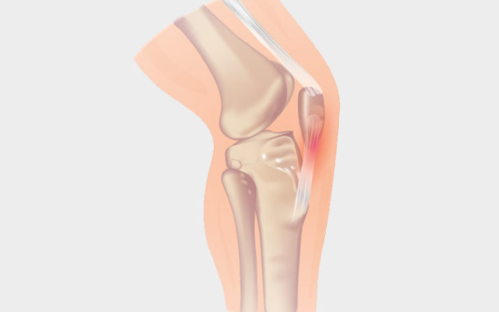 Behind Knee,Pain Behind Knee