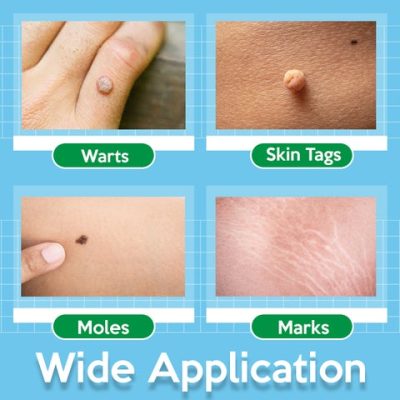 Skin Tag Remover,TagOff™ Skin Tag Remover
