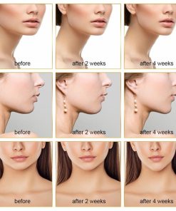 V Face,V Face Massager,Face Massager,Intelligent EMS V Face Massager