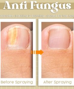 Anti Fungal Spray,Fungal Spray