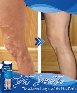 Varicose Veins Cream