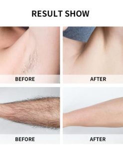 LCD Portable Laser Hair Removal Epilator