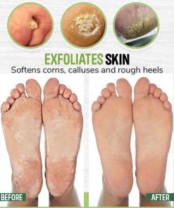 AntiFungal Foot Soak