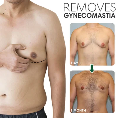 SoliPac Gynecomastia Reduction Ointment