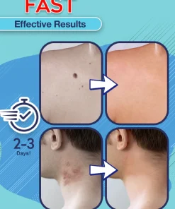Instant Skin Tag Removal