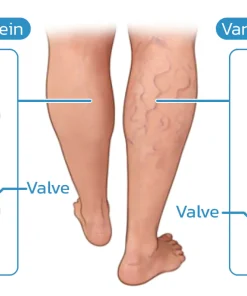 VeinHaart Varicose Veins Treatment Spray