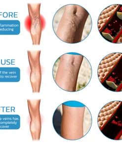 VeinHaart Varicose Veins Treatment Spray