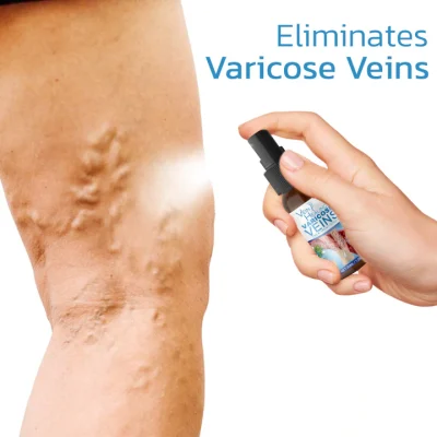 Varicose Veins Spray