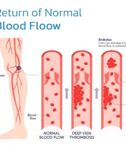 Varicose Veins Spray