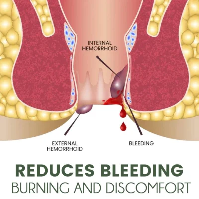 Korean Herbal Hemorrhoids Spray