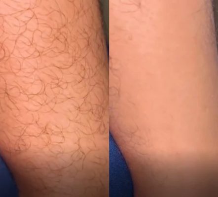 Focusothing | Silky Smooth Hair Eraser