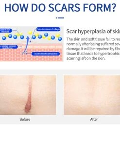 High Purity Silicone Scar Treatment Gel