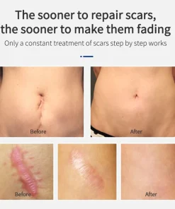 High Purity Silicone Scar Treatment Gel