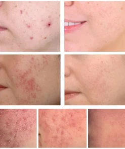 Ginseng Herbal Acne Cream