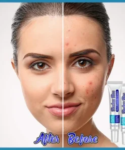Anti-Blemish Facial Cream