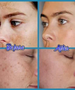 Anti-Blemish Facial Cream