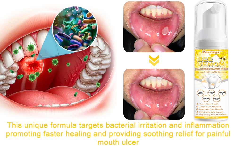 Zoencgz™ Bee Venom Oral Cleansing Treatment Mousse - Image 4