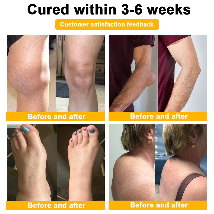 FLYCARE™ Bee Venom & Turmeric Arthritis Treatment Cream - Image 5