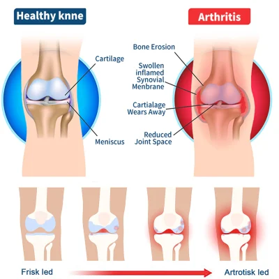 Posryst™ Bee Venom Joint and Gout Healing Gel