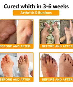 ArthroFree® Bee-Venom Pain Relief Bone Healing Cream