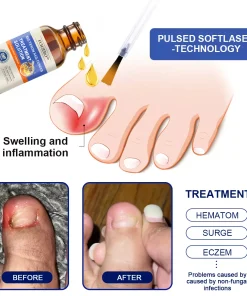 Furzero™ Bee Venom Nail Folliculitis Treatment Program