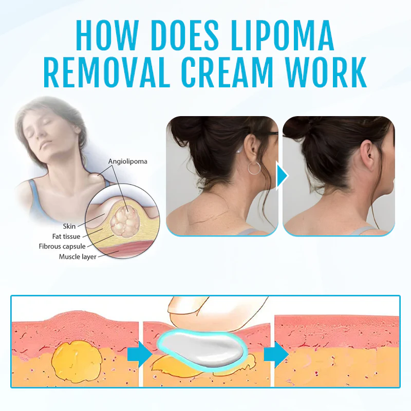Biancat™ LumpClear Lipoma Relief Cream - Imaj 3