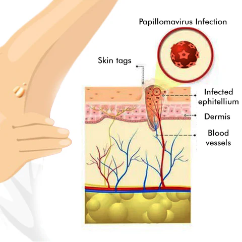 QIAWI™ BEE POSON MOLE AND WART TREATMENT CREAM - Image 4