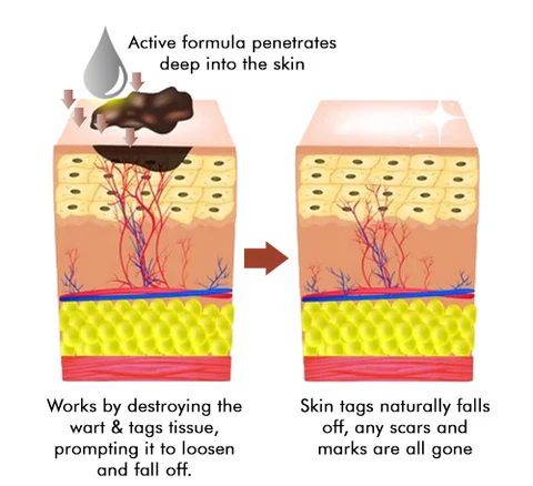 QIAWI™ BEE POSON MOLE AND WART TREATMENT CREAM - Image 5