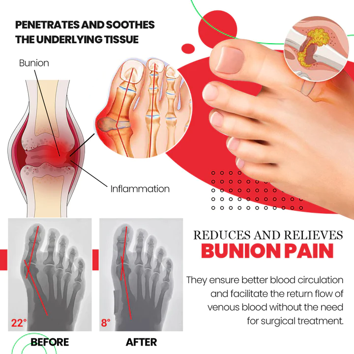 ToeAlign™ Bunion Cream & Corrector Set - Image 7