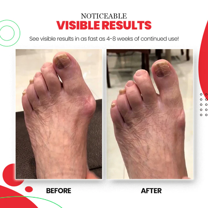 ToeAlign™ Bunion Cream & Corrector Set - Image 10