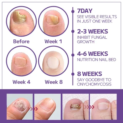 FLYCARE™ Bee Venom Nail Fungus Spray