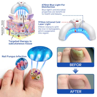 Furzero™ Effective Fungal Nail Treatment Laser Device