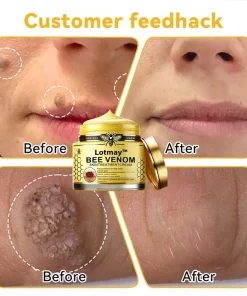 Lotmay™ Bee Venom Skin Treatment Cream