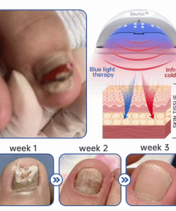 Seurico™ PureNail Fungus Laser Device
