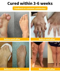 𝐓𝐧𝐧𝐞𝐝𝐞𝐲™ 𝐁𝐞𝐞 𝐕𝐞𝐧𝐨𝐦&𝐓𝐮𝐫𝐦𝐞𝐫𝐢𝐜 𝐀𝐫𝐭𝐡𝐫𝐢𝐭𝐢𝐬 𝐓𝐡𝐞𝐫𝐚𝐩𝐲 𝐂𝐫𝐞𝐚𝐦