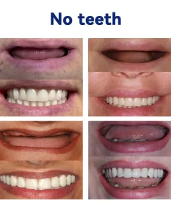 DIYSTAR™ 𝑆𝑖𝑙𝑖𝑐𝑜𝑛𝑒 𝐷𝑒𝑛𝑡𝑢𝑟𝑒 𝑅𝑢𝑙𝑒𝑟 𝑆𝑒𝑡