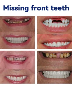 DIYSTAR™ 𝑆𝑖𝑙𝑖𝑐𝑜𝑛𝑒 𝐷𝑒𝑛𝑡𝑢𝑟𝑒 𝑅𝑢𝑙𝑒𝑟 𝑆𝑒𝑡