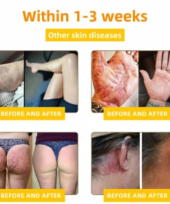 NESLEMY™ Bee Venom Skin Cream