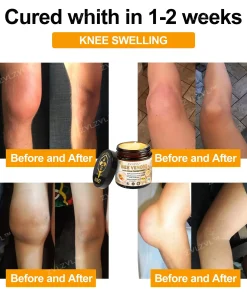 ZVLZVL™ Bee Venom Instant Pain Relief Arthritis Therapy Cream