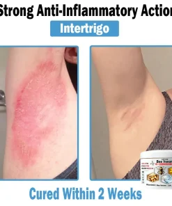 ADFIRE™ Bee Venom Multi-Symptom Skin Treatment Cream