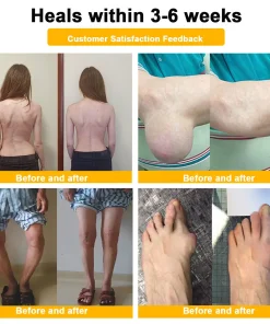 ADNOON™ Botulinum Toxin & Bee Venom Pain-Relief Bone Healing Cream