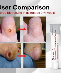 Glucarex™ Diabetes Treatment Cream