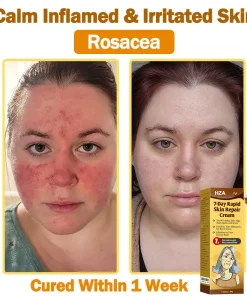 HZA®𝟕-𝐃𝐚𝐲 𝐑𝐚𝐩𝐢𝐝 𝐒𝐤𝐢𝐧 𝐑𝐞𝐩𝐚𝐢𝐫 𝐂𝐫𝐞𝐚𝐦