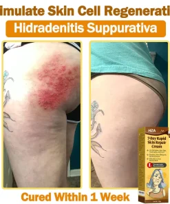 HZA®𝟕-𝐃𝐚𝐲 𝐑𝐚𝐩𝐢𝐝 𝐒𝐤𝐢𝐧 𝐑𝐞𝐩𝐚𝐢𝐫 𝐂𝐫𝐞𝐚𝐦