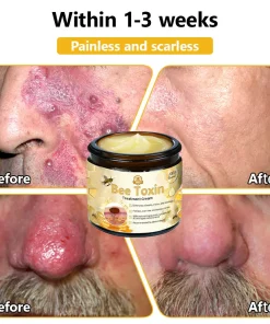 HZA™ Bee Toxin Skin Treatment Cream