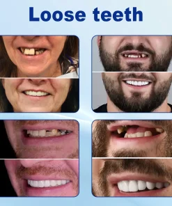 Nurbini™ Advanced Customized Full Denture Set