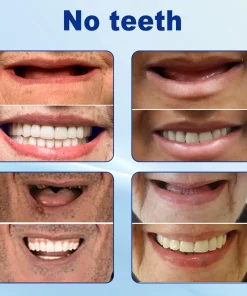 Nurbini™ Advanced Customized Full Denture Set