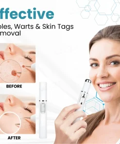 Nurbini® Non-invasive Mole and Wart Removal Laser Pen