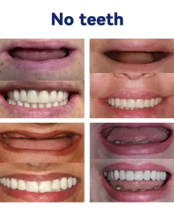 QIAWI ™-🦷Advanced Customized Full Denture Set